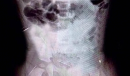 Nghi phạm đâm 16 mũi kim khâu vào người cháu gái tự tử