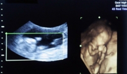 Phẫu thuật tim cho thai nhi 27 tuần tuổi trong bụng mẹ