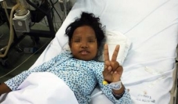 Bé gái 10 tuổi bị ong vò vẽ đốt gần 90 vết