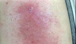 Cư dân Dương Nội hoang mang vì bị kiến ba khoang tấn công