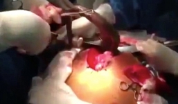 Phẫu thuật lôi con cá chình dài gần 1 mét ra khỏi bụng bệnh nhân