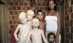 Kỳ lạ bố mẹ da đen sinh ra 3 con da trắng