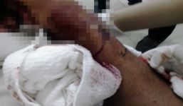 Chủ quán từ chối bảo kê, bảo vệ bị giang hồ chém đắt hai tay