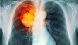 Ung thư phổi tàn phá cơ thể như thế nào?