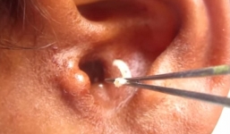 Chàng trai bị hàng trăm con giòi 'ăn thịt' bịt kín lỗ tai