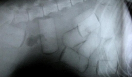 Bố bắt con gái 11 tuổi nuốt 0,5 kg ma túy vào bụng