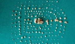 Kinh ngạc bé gái có 202 chiếc răng trong miệng