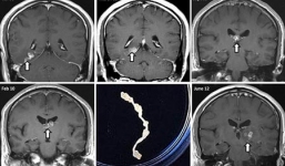 Phát hiện sán xơ mít ký sinh trong não người suốt bốn năm