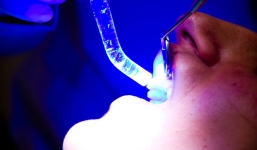 Phẫu thuật nhổ bỏ 202 chiếc răng thừa trong miệng bé 7 tuổi 