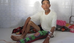 Heo rừng nặng hơn 1 tạ tấn công, 2 người dân bị cắn nát chân