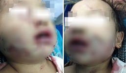 Bị chó tấn công vào mặt, phải dùng 9 cuộn chỉ y khoa để khâu vết thương