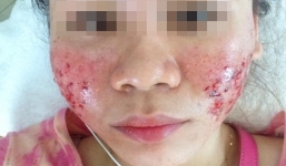 Cô gái bị hỏng mặt sau khi xóa sẹo ở viện thẩm mỹ