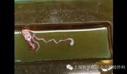 Phát hiện ký sinh trùng dài 8 cm trong não bé 11 tuổi