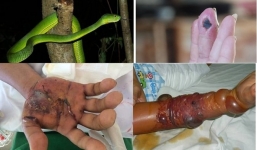 Truyền gần 46 lít máu cứu bệnh nhân bị rắn lục cắn