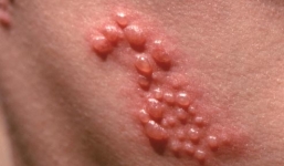 Bệnh sùi mào gà có thể tự khỏi 