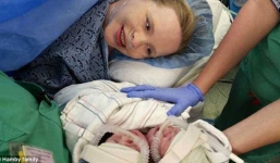 Cặp sinh đôi dính liền có chung một trái tim