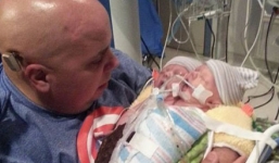 Em bé hai đầu tử vong sau 48 giờ chào đời