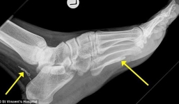 Hãi hùng phát hiện giun chỉ dài 1 mét sống trong chân ít nhất 4 năm