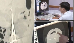 Bác sĩ bỏ quên kéo trong bụng bệnh nhân suốt 12 năm