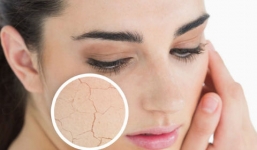Cách trị da khô, nứt nẻ trong ngày đông