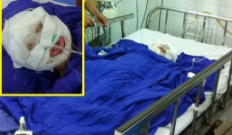 Bố lên nương, bé 4 tuổi ở nhà bị bỏng xăng nguy kịch