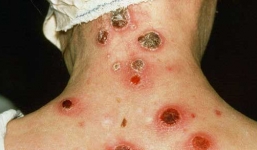 Những hình ảnh 'kinh khủng' khi mắc bệnh giang mai