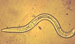 Ký sinh trùng dài 2m trong cơ thể người 4 năm