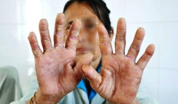 'Bệnh lạ' tái xuất ở Quảng Ngãi