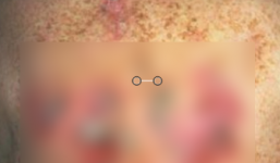 Bệnh lậu nguy hiểm như thế nào?