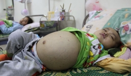 Những hình ảnh đáng sợ ký sinh trùng trên cơ thể người