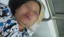 Một phụ nữ 8 lần nhập viện cấp cứu vì bị chồng hành hung dã man