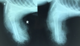 Gấu nặng 100kg tấn công bé 3 tuổi: Cánh tay bị cắn không thể nối lại