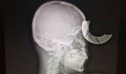 Thoát chết kỳ diệu dù bị cưa cắm vào đầu