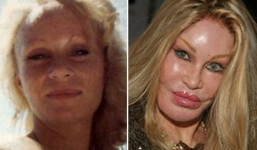 Những hình ảnh biến chứng của bơm môi quá đà