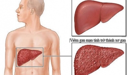 Những dấu hiệu sớm của bệnh xơ gan