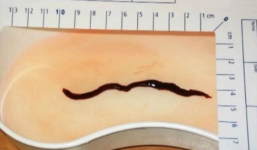 Giun dài 10cm 'ăn' thận khiến người phụ nữ tử vong