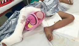 Cho khỉ ăn, bé trai 8 tuổi bị cắn đứt dây thần kinh