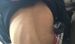 Nỗi đau tột cùng của người mẹ nuôi 2 con cơ thể cứ teo dần