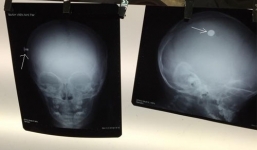 Ngủ say lăn khỏi giường, bé trai 17 tháng tuổi bị đinh đâm thủng đầu