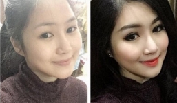 Hương Tràm tự tin chia sẻ ảnh trước và sau khi phẫu thuật
