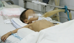 Phú Yên:Bé gái 22 tháng tuổi nguy kịch vì uống nhầm thuốc diệt cỏ cực độc