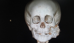 Cậu bé sống sót kỳ diệu dù bị hơn 300 viên đạn găm vào mặt