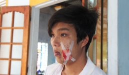 Công an xã bắn lạc đạn cao su trúng mặt người vi phạm giao thông