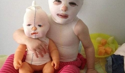 Bé gái 2 tuổi mắc bệnh lạ phải bọc kín như người ngoài hành tinh