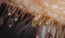 Bé gái 4 tuổi bị hàng chục con rận mu ký sinh trên mắt