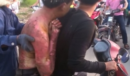 Clip: Taxi từ chối chở nạn nhân cháy sém đi cấp cứu