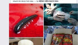 Sự thật ca phẫu thuật toàn đỉa trong bụng người tại BV Bạch Mai