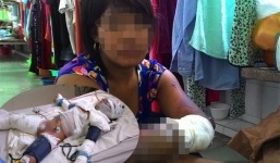 Câu nói nhói lòng của bé gái bị bố tẩm xăng đốt