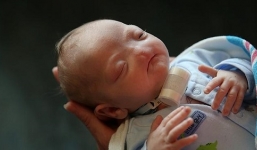 Những ngày đầu đời của cậu bé không có mũi