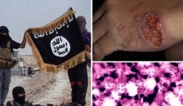 Clip: Hình ảnh kinh hãi binh sĩ IS bị vi khuẩn ăn thịt người tấn công